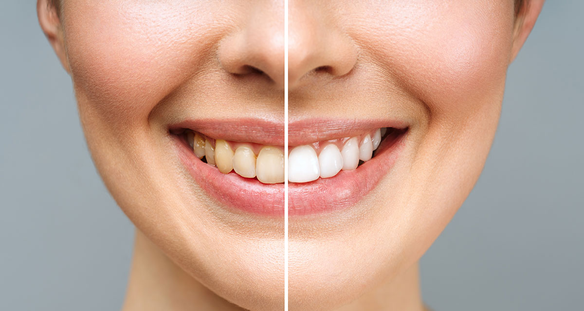porto-odontolgia-tratamentos-clareament-dental