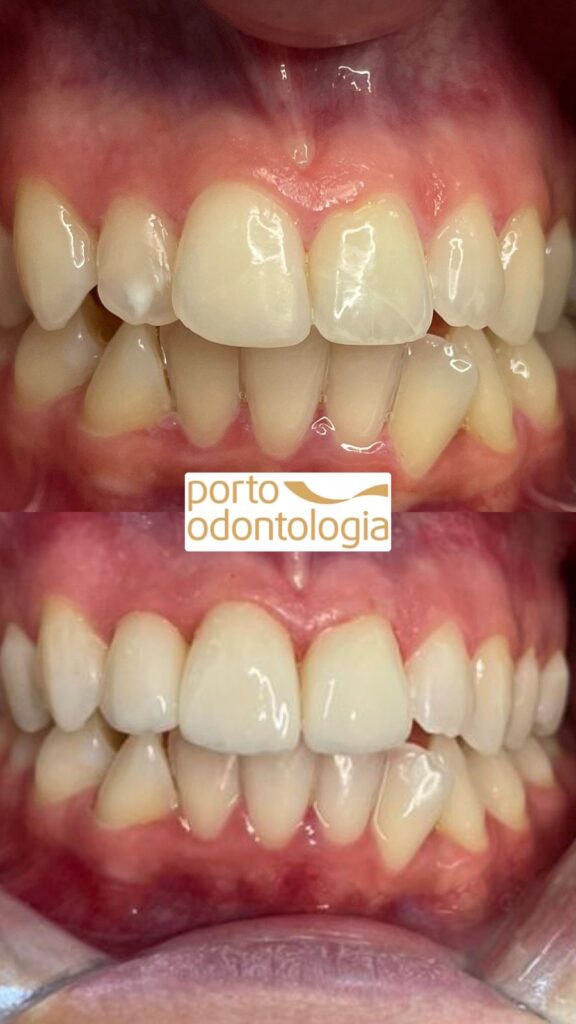 Esse é um antes e depois que fizemos em um paciente para clarear dentes